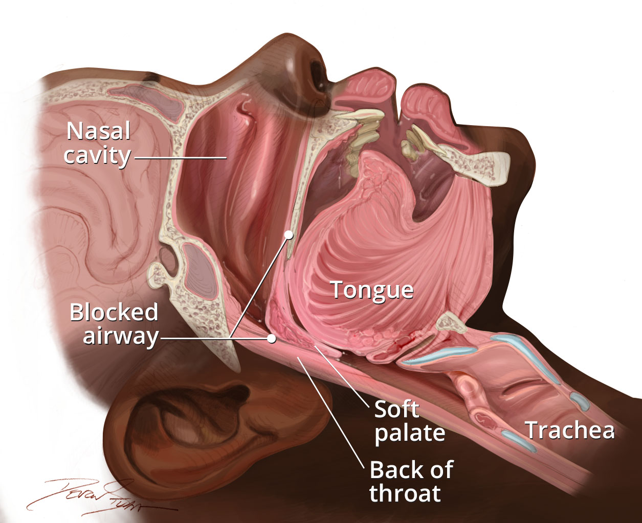 Sleep Apnea Treatment